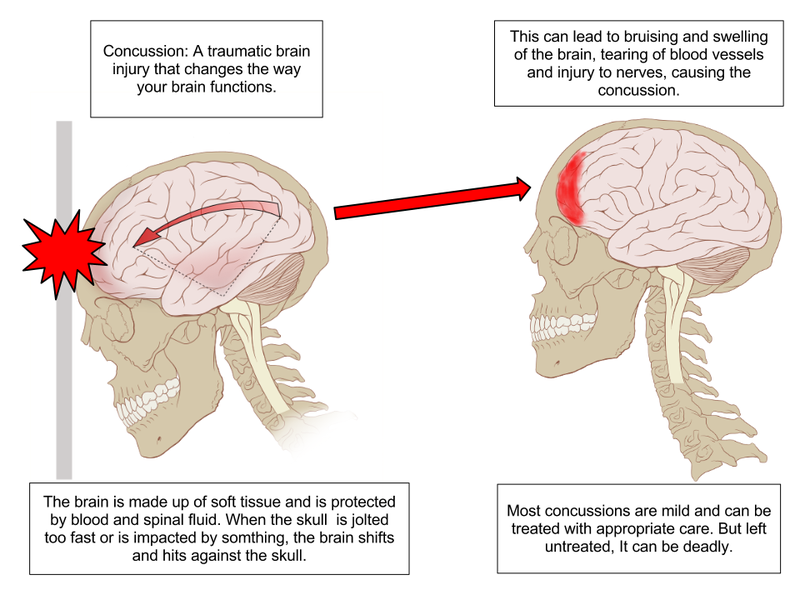 Concussions+are+a+serious+injury+that+harm+many+high+school+athletes+each+year.+The+diagram+shown+above+is+a+break+down+of+what+happens+to+the+brain+in+order+to+become+concussed.