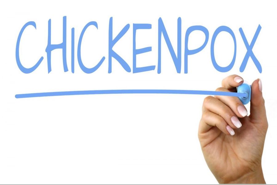 Students should be aware of chickenpox virus – The Eclipse